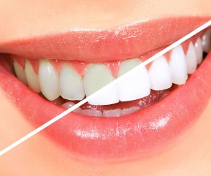 Evde Diş Beyazlatma Yöntemleri ve Diş Beyazlatıcı Kürler
