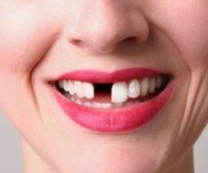 Yerinden Çıkan Diş Tedavi Edilebilir Mi?