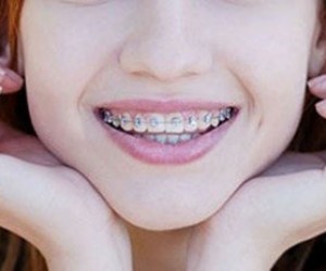 Diş Teli Neden Kullanılır?