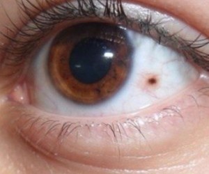 Göz Tümörü Nasıl Tedavi Edilir?