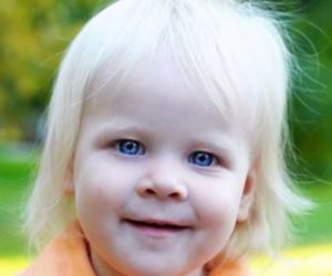 Albinizm Nedir? (Bilinmesi Gerekenler)