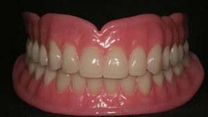 Takma Diş (Hareketli Protez) Nasıl Yapılır?